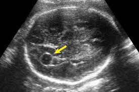<p>Choroid plexus </p>