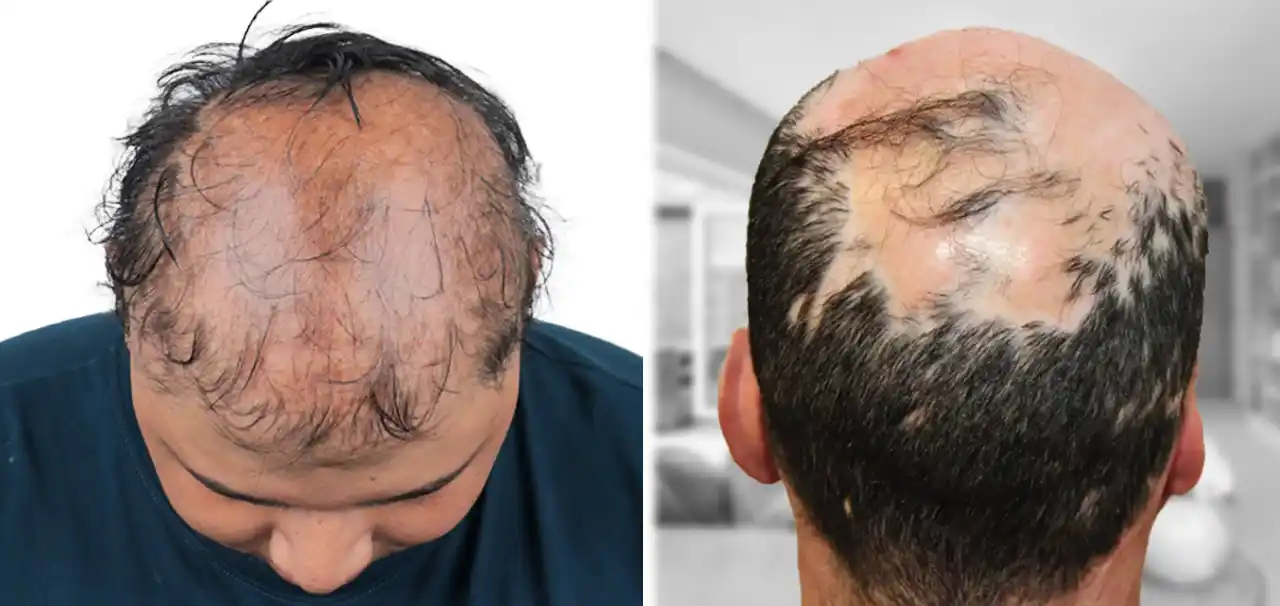 <p>Cicatricial alopecia</p>
