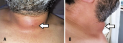 <p>aka bacterial. suppurative thyroiditis.</p><p>VERY RARE</p><p>usually immonocompromised patients</p><p>very ill, fever, dysphagia, anterior neck pain, </p><p>TFT's usually normal but can get high or low T4 symptoms increased WBC, ESR</p><p>diagnosis: biopsy</p><p>treatment: pain medications, antibiotics, drain abscess</p>