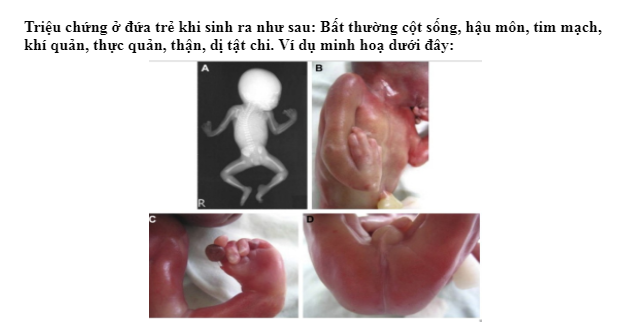 <p>Câu hỏi trong hình:</p><p>A. Hội chứng Meckel Gruber</p><p>B. Hội chứng VACTERL</p><p>C. Hội chứng POTTER</p><p>D. Hội chứng CHARGE</p>
