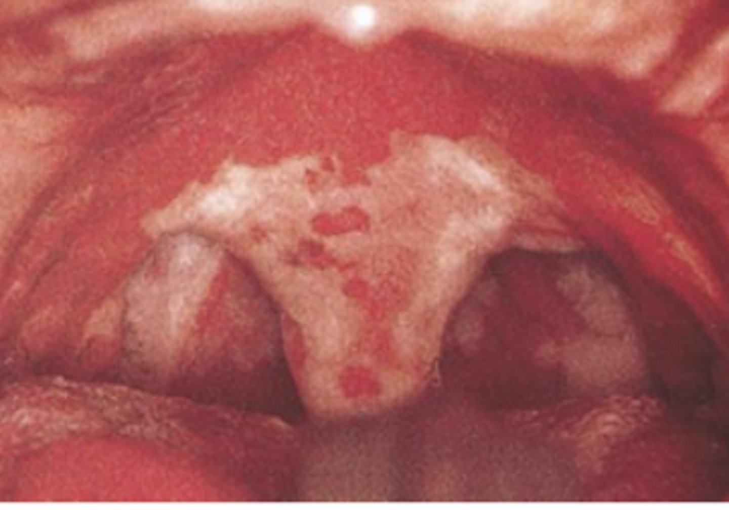 <p>Diphtheria, an acute infection caused by Corynebacterium diphtheriae, is now rare but still important.&nbsp;</p><p>Prompt diagnosis may lead to life-saving treatment.&nbsp;</p><p>The throat is dull red, and a gray exudate (pseudomembrane) is present on the uvula, pharynx, and tongue.&nbsp;</p><p>The airway may become obstructed.</p>