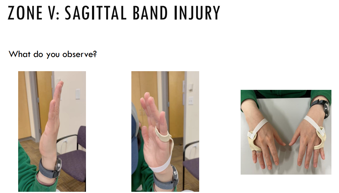 <p><span style="color: rgb(242, 154, 0);"><strong>Zone V/5</strong></span> Extensor Injury: <strong>Sagittal Band Injury “Boxer’s Knuckle” - What do you observe?</strong></p>