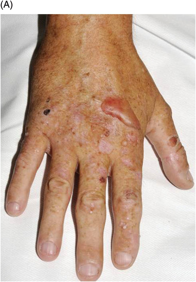 <p><span>Separation of skin layers causing fluid-filled spaces. Can be intraepidermal or subepidermal. May feature acantholysis(loss of intercellular connections between keratinocytes). </span></p>
