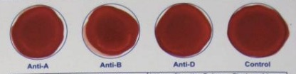 <p><strong>Identify the blood type indicated by the test results in the image.</strong></p>
