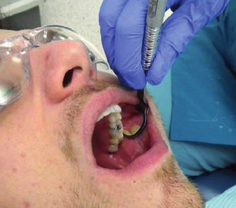 <ul><li><p>3 o’ clock position</p></li><li><p>Place the mirror head between dental arches, rest ring and pinkie on left side of patient’s face. Retract the buccal mucosa with mirror. </p></li><li><p>Use mirror for indirect vision, to view distal suerfaces.</p></li><li><p>Swivel mirror head until you can easily view distal surfaces in reflection. </p></li></ul><p></p>