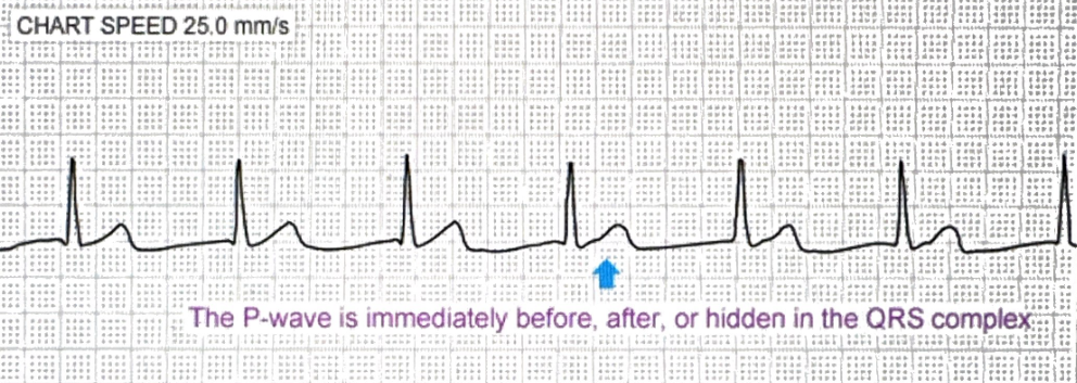 <p>Narrow regular rhythm with absent/inverted/after-QRS P waves</p>