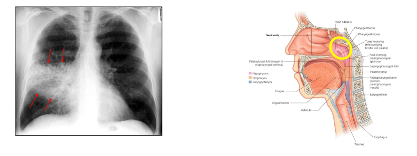 <p>S. pneumoniae carriage</p>