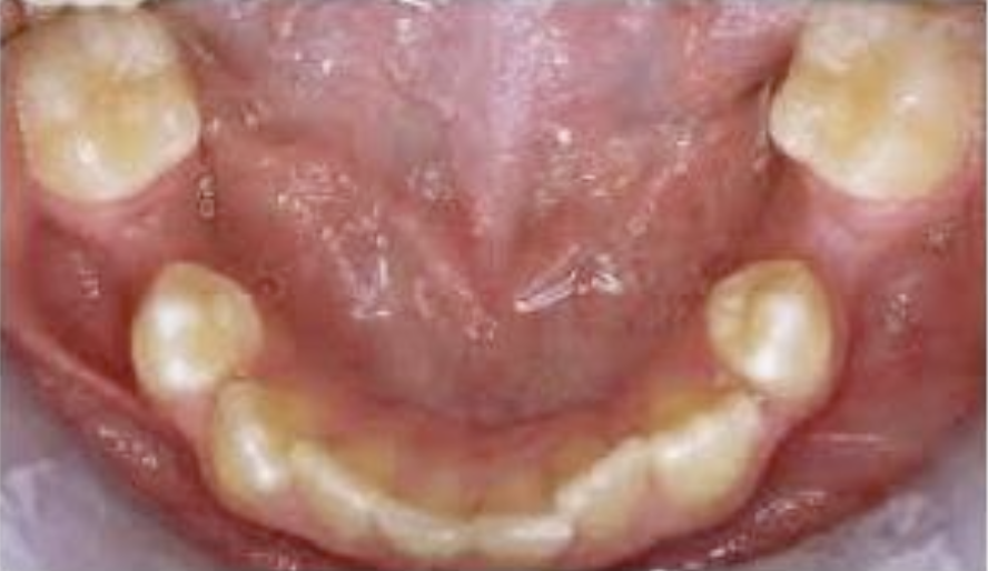 <p>A patient presents to your office and you take the attached clinical photograph. A panoramic film was also taken to confirm that the patient is in fact missing one set of mandibular premolars. The appropriate diagnosis for this patient is what?</p><p>A. Supernumerary teeth </p><p>B. Hyperdontia </p><p>C. Hypodontia </p><p>D. Oligodontia </p><p>E. None of the above </p>