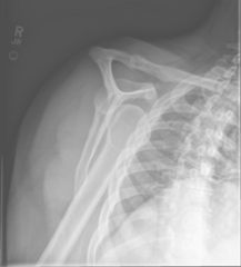 <p>PE:</p><p>- AC step-off</p><p>- ROM</p><p>- neurovascular status</p><p>Imaging:</p><p>- Y-view XR</p>