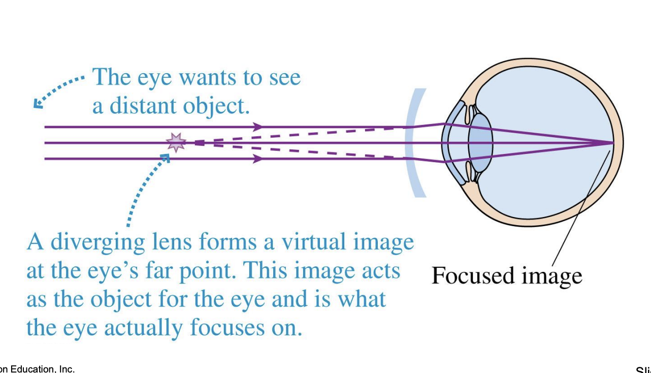 <p>-To correct myopia, we needed a diverging lens to slightly defocus the rays and move the image point back to the retina</p><ul><li><p>f<0, P<0</p></li></ul><p>*spread rays out so converge on retina</p>