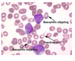 <p>with lead poisoning anemia what would we see on a peripheral smear</p>