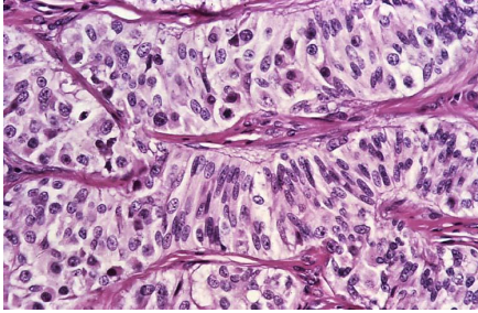 <p>Tumor de células de Sertoli o SERTOLINOMA</p><ul><li><p>mas frecuente (40%) </p></li><li><p>produce estrogenos (feminización: ginecomastia, prepucio péndulo) </p></li><li><p>proliferación intratubular de celulas alargadas </p></li></ul><p></p>