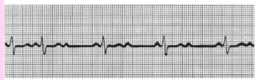 <p>some P waves are conducted through the AV node; ratio of P waves to QRS waves is ~2:1; slow heart rate</p>