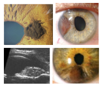 <p>What is the most likely diagnosis ?</p>