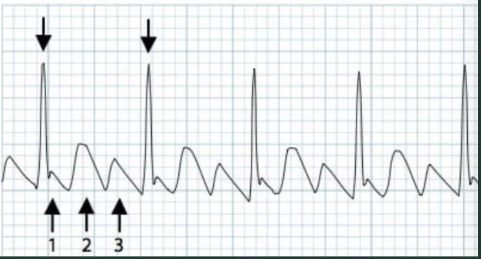 <p>What does this ECG depict?</p>