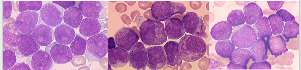 <p>- Cause unknown</p><p>- Affects children and adults (increase with age)</p><p>- Replacement of marrow by leukaemic ("blast") cells</p><p>- Lymphoid or myeloid lineage</p><p>- Reduction in normal cells</p><p>- Treatment: chemotherapy; transplant</p><p>- "Supportive care": transfusions; antibiotics</p>