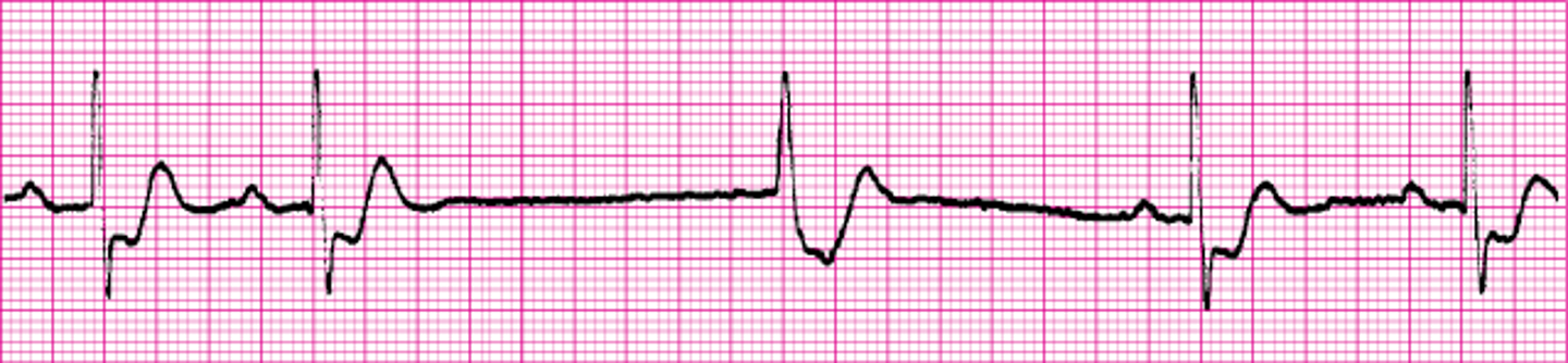 <p>Junctional Escape Beat</p>
