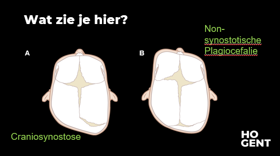 <p>Een afplatting van het hoofd als gevolg van de ligging in utero (bv: meerlingenzwangerschap) of onder invloed van een voorkeurshouding bij rugligging.</p><p>=> Door voortdurende remodellering van de schedel tijdens de groei verminderd de afplatting binnen 1-2 jaar, uiteindelijk is het alleen nog te zien voor een geoefend oog. Bij een voorkeurshouding kan fysiotherapie nuttig zijn. Ook eenvoudige zaken als het bed verplaatsen (dus plaats waar ze naar kijken) helpen.</p>