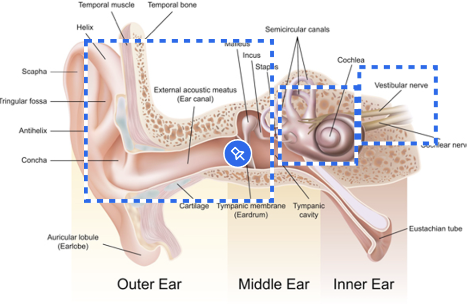 <p>blockages in outer to middle ear near tympanic membrane (TM)</p>