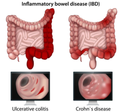 <p>-Any part of the entire GI tract from the mouth to the amus</p><p>-Mostly terminal ileum (last part of small intestine) and colon</p><p>-Small intestine, anus, mouth</p><p>-Discontinuous inflammation, patches of disease intermixed with areas of normal GI mucosa (skip legions, cobblestone pattern)</p>