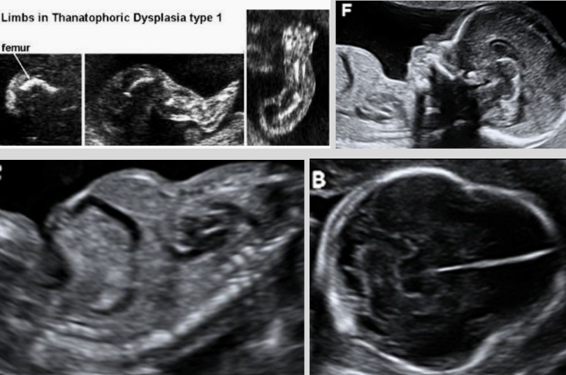 <ul><li><p><span style="background-color: transparent;">Severe short-limb dwarfism syndrome that is usually lethal in perinatal period</span></p></li><li><p><span style="background-color: transparent;">Most common form of lethal skeletal dysplasia due to breathing difficulties that lead to respiratory failure</span></p><ul><li><p><span style="background-color: transparent;">Thanatophoric - Greek for “death bearing”</span></p></li></ul></li><li><p><span style="background-color: transparent;">Poor prognosis, still birth, or death after birth due to pulmonary hypoplasia</span></p></li><li><p><span style="background-color: transparent;">More common in males</span></p></li><li><p><span style="background-color: transparent;">Etiology - autosomal dominant inheritance of FGFR3 gene</span></p></li><li><p><span style="background-color: transparent;">Two types</span></p></li><li><p><span style="background-color: transparent;">Associated w/ macrocephaly, hydrocephalus, patent ductus arteriosus, ASD, horseshoe kidney, hydronephrosis, and imperforate anus</span></p></li><li><p><span style="background-color: transparent;">US findings:</span></p><ul><li><p><span style="background-color: transparent;">Frontal bossing <u>(clover-leaf skull)</u></span></p></li><li><p><span style="background-color: transparent;">Hypoplastic thorax (small thorax w/ normal trunk)</span></p><ul><li><p><span style="background-color: transparent;"><u>Bell-shaped chest</u></span></p></li></ul></li><li><p><span style="background-color: transparent;">Curved long bones</span></p></li><li><p><span style="background-color: transparent;">Hypomineralization</span></p></li><li><p><span style="background-color: transparent;">Macrocephaly</span></p></li><li><p><span style="background-color: transparent;">Fetal bones are normal</span></p></li></ul></li></ul><p></p>
