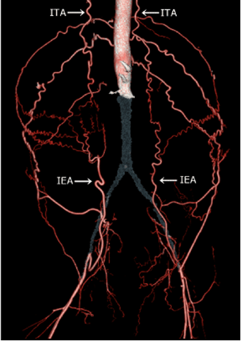 <p>arterial occlusion</p>