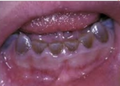 <ul><li><p>Affects both primary and permanent dentition.</p></li><li><p>Have blue brown discoloration</p></li><li><p>With distinctive translucence</p></li><li><p>Enamel frequently separates easily from underlying defective dentin.</p></li></ul><p></p>