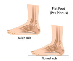 <p>Severe pronation, can see bunion</p><p>Gait analysis... shoes on and off</p><p>Achilles alignment, angulated rather than vertical</p>