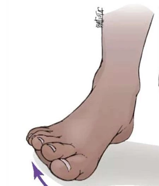 <p>outward rotation of foot</p>