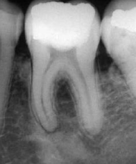 <p>large restoration, infection, borders ill defined </p>