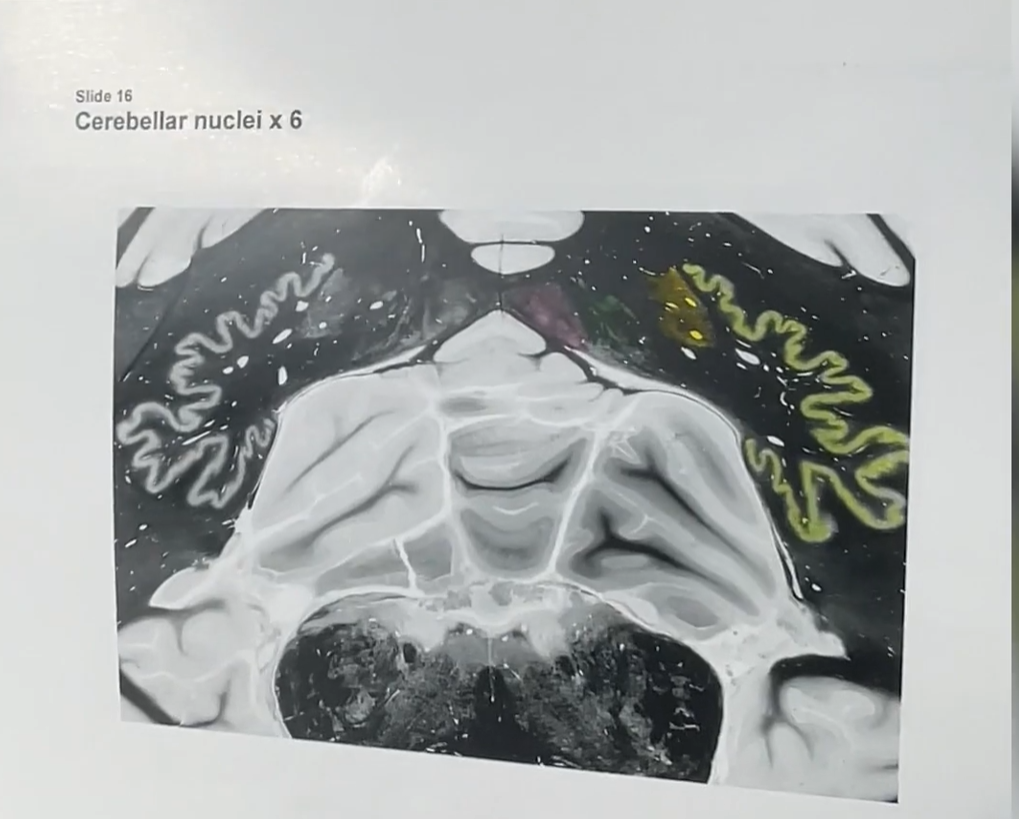 <p>Supplemental image so we can talk about the cerebellar nuclei. </p><p>The swiggly green structure is the dentate nucleus that we were able to see grossly. </p>
