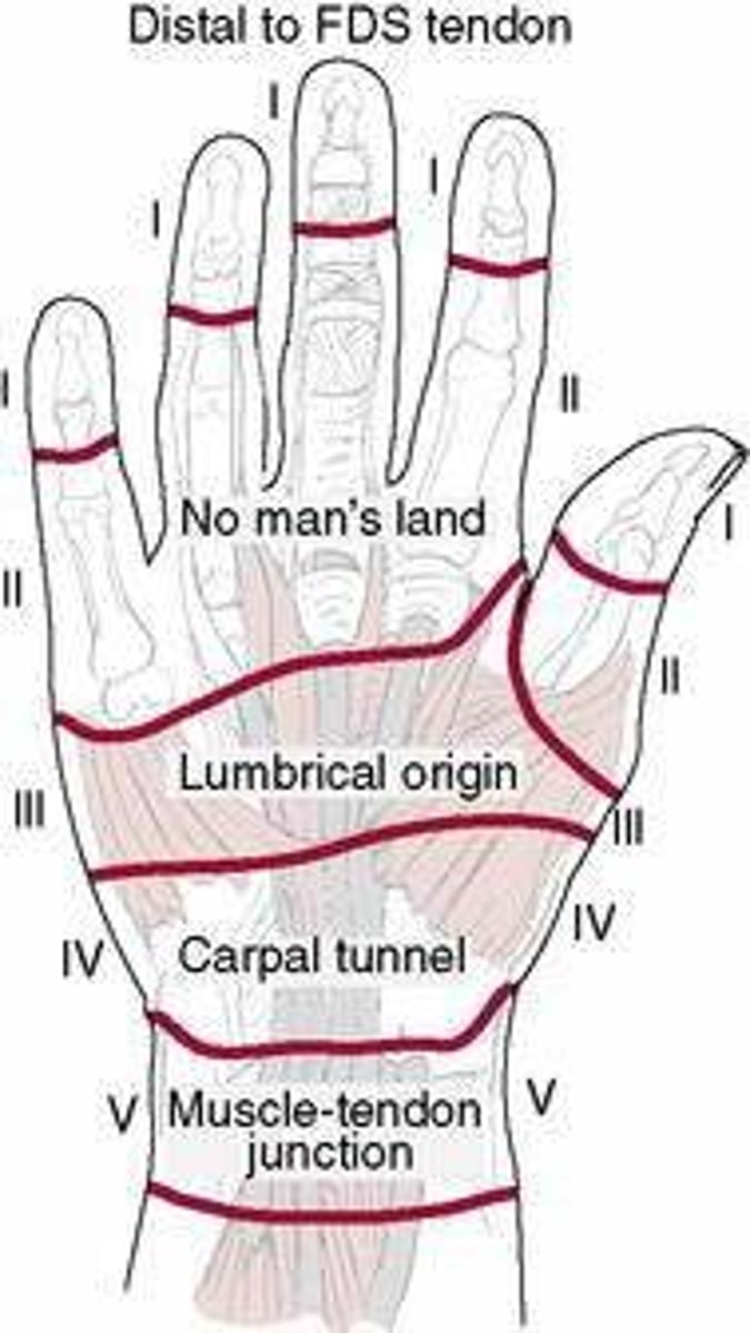 <p>5 Different Zones:</p><p>Zone 1: Distal to Flexor Digitorum Superficialis insertion</p><p>Zone 2: A1 Pulley to Flexor Digitorum Superficialis insertion</p><p>Zone 3: Distal end of the Carpal Tunnel to A1 Pulley</p><p>Zone 4: Within the Carpal Tunnel</p><p>Zone 5: Proximal to the Carpal Tunnel</p><p>3 Thumb Zones:</p><p>-Zone 1: Distal to IP joint</p><p>-Zone 2: Between the MP &amp; IP joints</p><p>-Zone 3: Thenar Eminence</p>