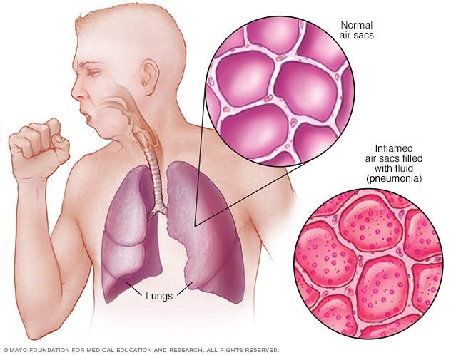 <p><span style="color: red;">pneumonia (n)</span></p>