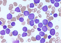 <ul><li><p><span style="color: rgb(255, 246, 246);">Myeloproliferative neoplasms</span> feature <span style="color: red;">proliferation of myeloid lineages (granulocytes, erythroid cells, megakaryocytes)</span></p></li><li><p>Chronic myelogenous leukemia (CML) can transform into acute leukemia (blast crisis)</p><ul><li><p>indolent course</p></li><li><p><span style="color: red;">Philadelphia chromosome</span>, translocation chromosomes 9, 22, bcr-abl</p></li></ul></li></ul><p></p><ul><li><p>Hematologic</p></li></ul><p></p>