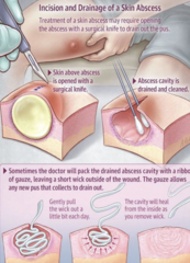 <p>incision and drainage </p><p>with or without a bacterial culture</p>