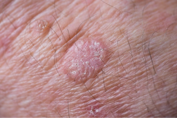 <p>Precursors to the development of skin cancers</p><p>UV radiation may induce abnormal keratinocyte changes</p>