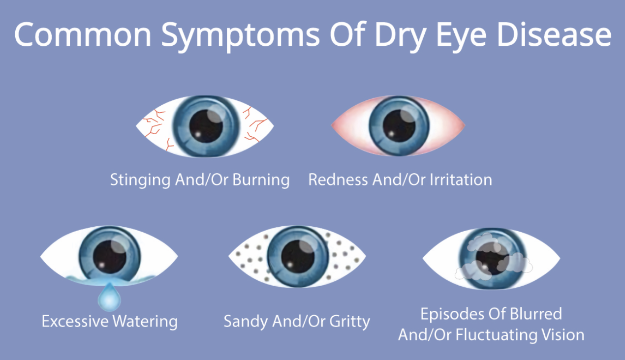 <p>PP/E: mimic for eye conditions</p><p>CM: bruning<br>itching<br>redness<br>tearing<br>foreign body sensation<br>gritty feeling<br>blur→clears with blinking</p><p>TX: depends on type of dry eye</p>