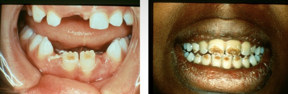 <p>Enamel hypoplasia </p>