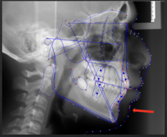 <p>which anatomical landmark:</p><p>- Most anterior point on the curve of the soft tissue chin</p>