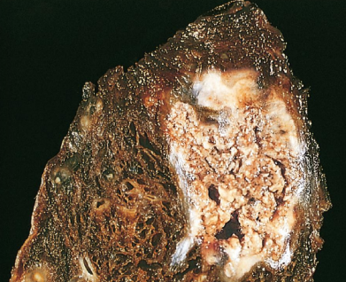 <p>What type of necrosis is this </p>