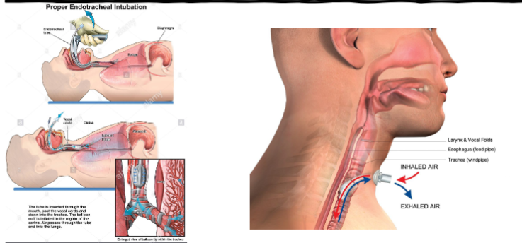 <ul><li><p>short term <14 days</p></li><li><p>can suction bc pt can’t cough</p></li><li><p>ensure balloon is filled so air doesn’t leave the mouth</p></li></ul><p></p>