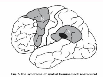 <ul><li><p>Caused by damage (usually a stroke) in the brain’s cerebral cortex <strong>on one side</strong></p><ul><li><p>In the parietal lobe, close to the temporal lobe (gray region marked ‘A’ and especially the black spot within it</p></li></ul></li><li><p>Patient is unaware of the left half of the world and usually doesn’t realize that they’re unaware</p></li></ul><p></p>