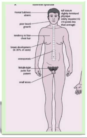<p>• Abnormal testicular development accompanied by the presence of one or more extra X chromosomes more than the normal male XY complement.</p><p>• Most males with Klinefelter syndrome have one extra X chromosome, resulting from nondisjunction during meiotic division in one of the parents (a cell division error).</p>