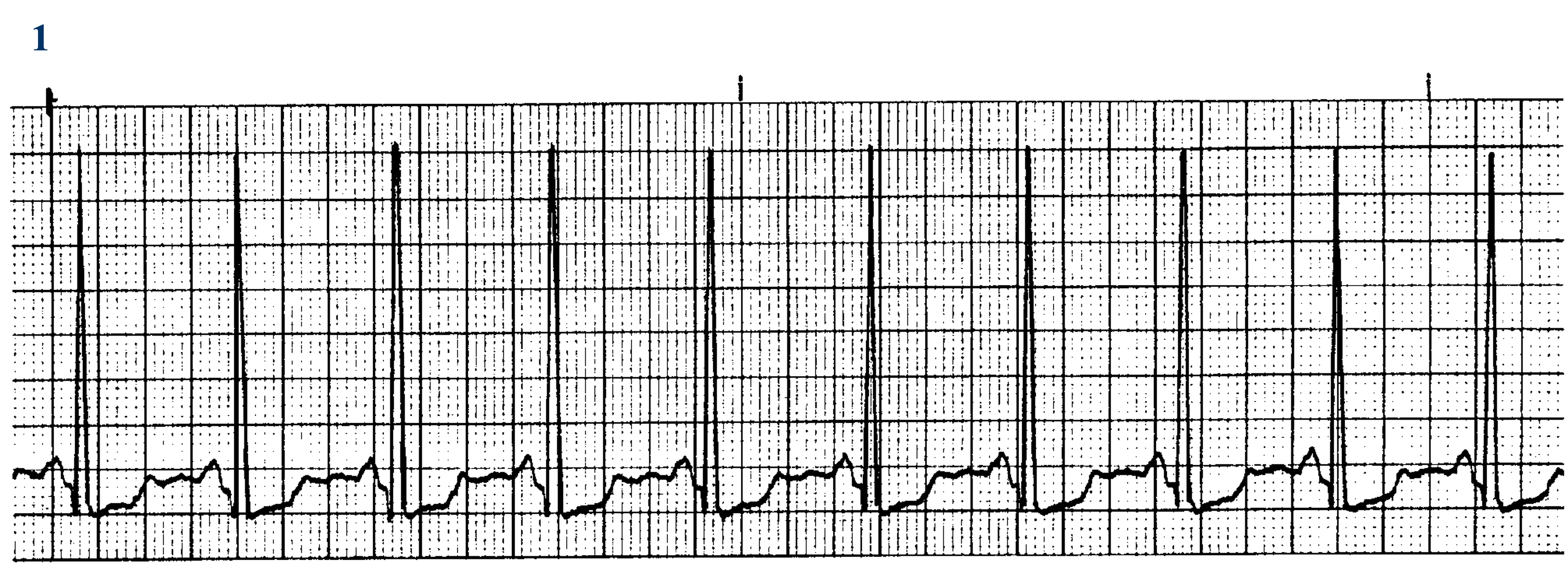 <p>What ECG is this? </p>