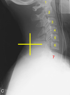 <p>Lateral C-Spine: Is this Image Good?</p>