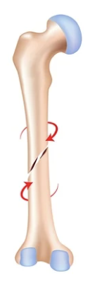<p><strong>Corkscrew-shaped fracture</strong> caused by <strong>twisting or rotational forces</strong>, hallmark of <strong>rotational trauma</strong>.</p>