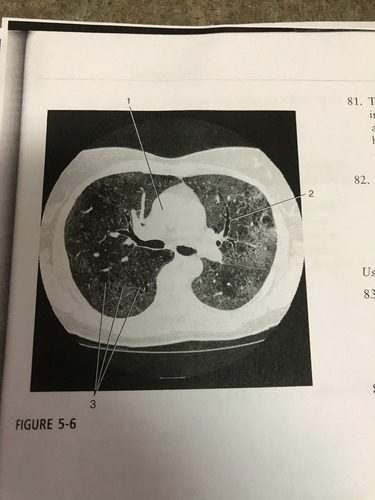 <p>The pathological process indicated by number 3 on the figure most likely corresponds to: </p><p>A) atelectasis </p><p>B) lymphadenopathy</p><p>C) pleural effusion </p><p>D) ground- glass opacity </p>