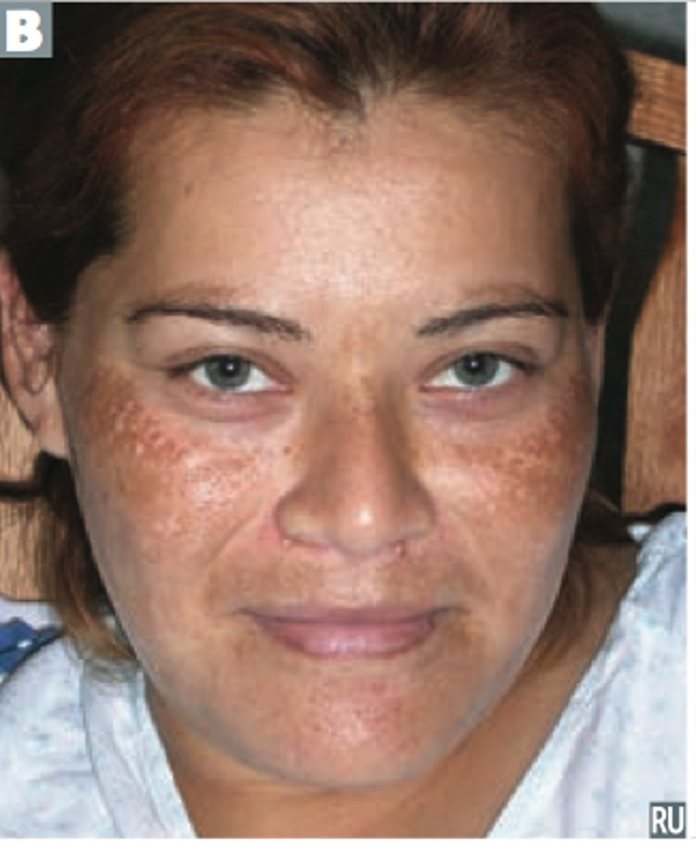 <p>hyperpigmented patches</p><p>- cheeks, upper lip, forehead (symmetric)</p><p>- caused by sun exposure, hormone (pregnancy)</p><p>- most common in young women</p>