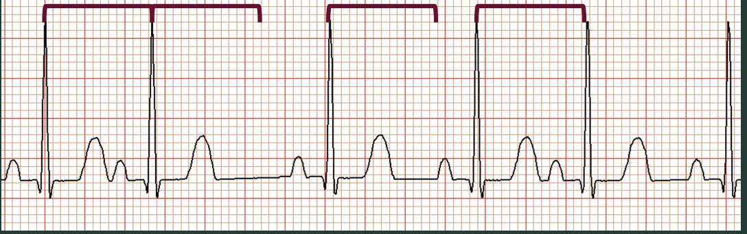 <p>Identify this rythm?</p>