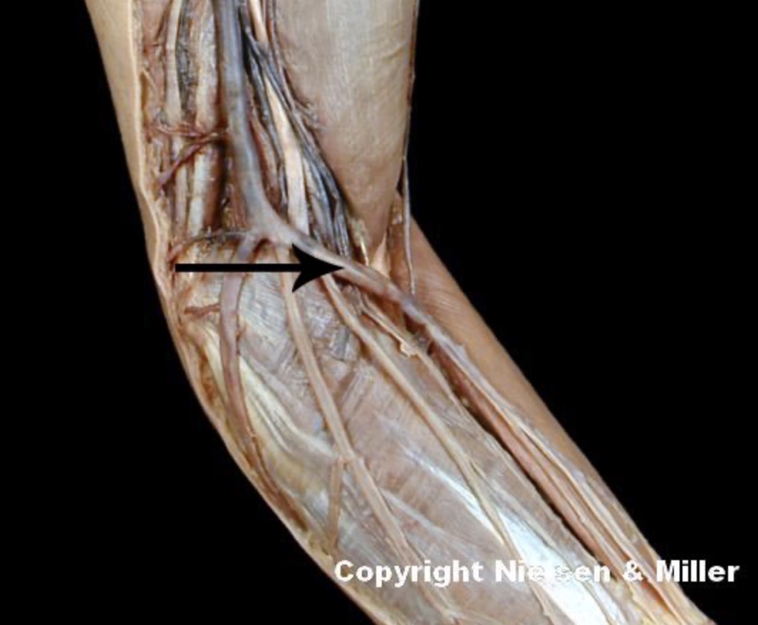 <p>The indicated vessel is the _ (anteromedial view of superficial veins of arm/forearm) it is the preferred site for removal of _</p>